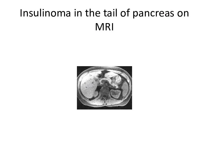 Insulinoma in the tail of pancreas on MRI