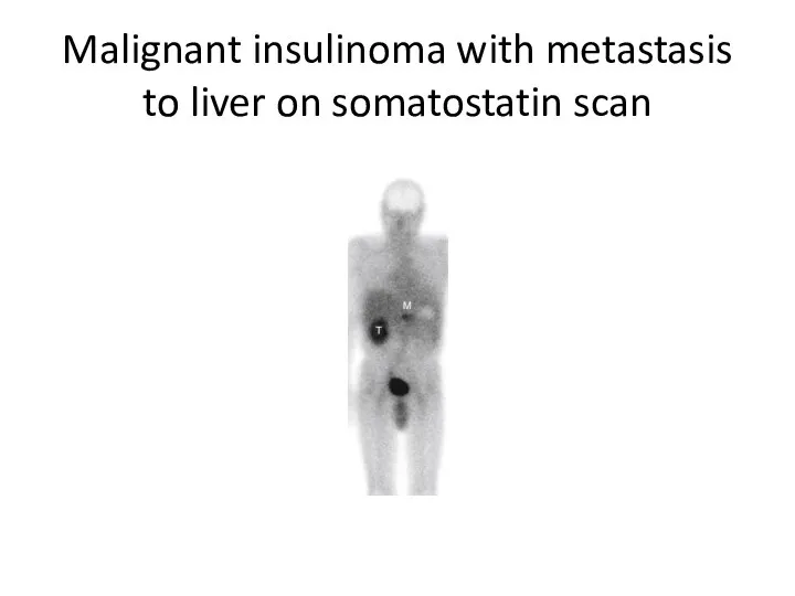 Malignant insulinoma with metastasis to liver on somatostatin scan