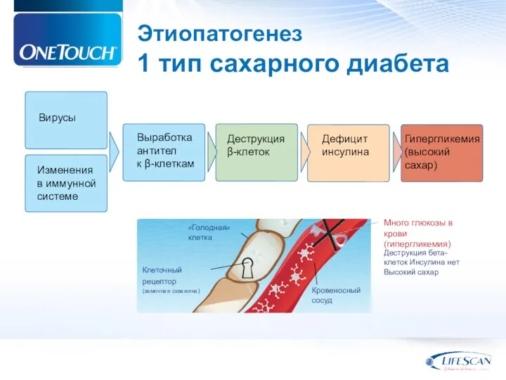 Этиопатогенез 1 тип сахарного диабета Вирусы Изменения в иммунной системе