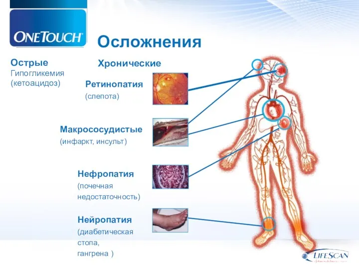 Осложнения Острые Гипогликемия (кетоацидоз) Нефропатия (почечная недостаточность) Нейропатия (диабетическая стопа,