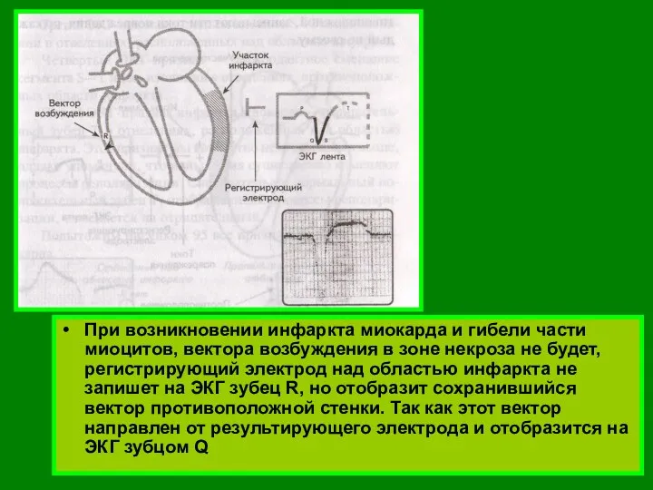 При возникновении инфаркта миокарда и гибели части миоцитов, вектора возбуждения