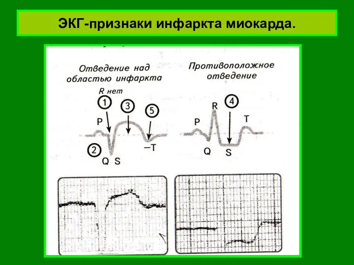 ЭКГ-признаки инфаркта миокарда.