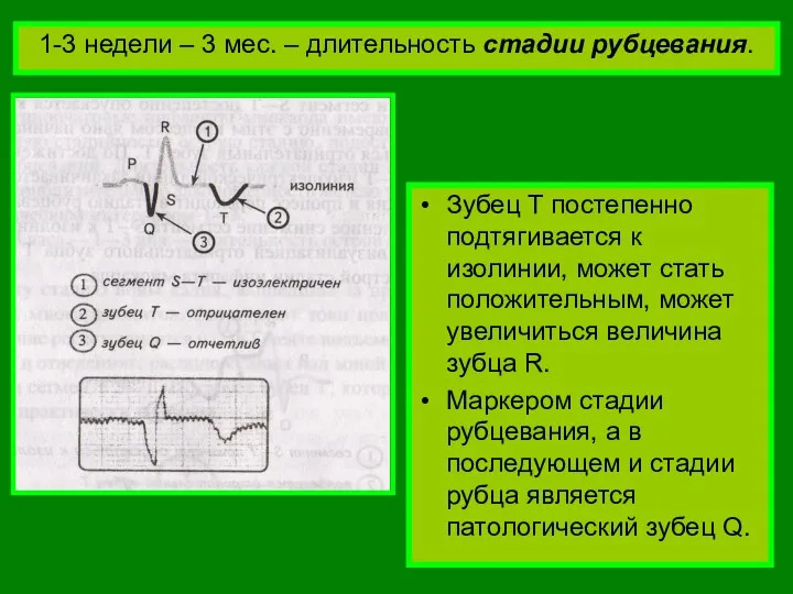 1-3 недели – 3 мес. – длительность стадии рубцевания. Зубец