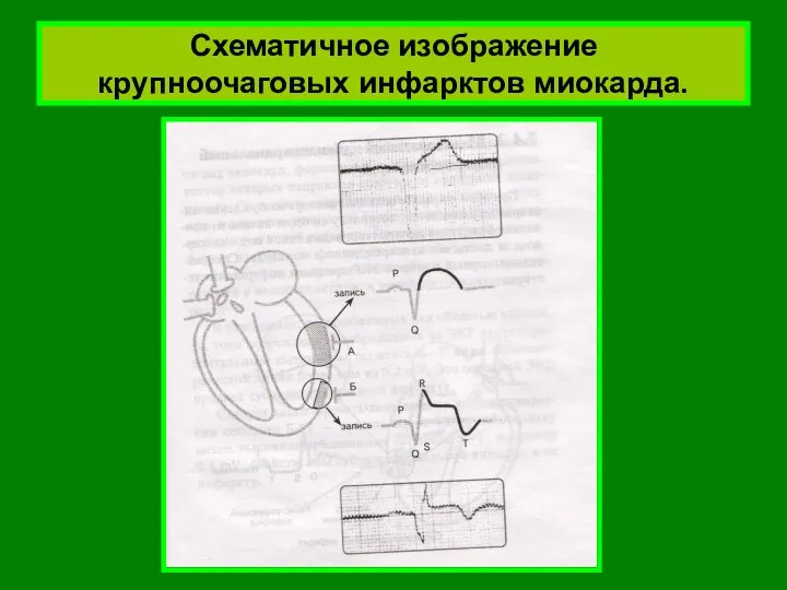 Схематичное изображение крупноочаговых инфарктов миокарда.