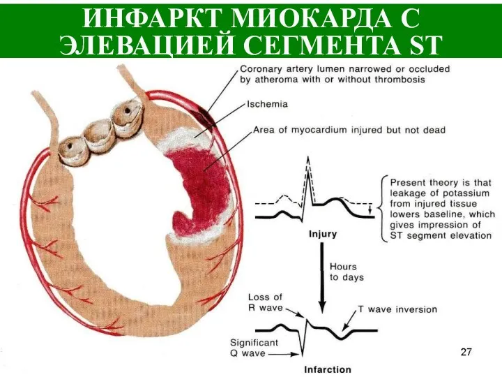 ИНФАРКТ МИОКАРДА С ЭЛЕВАЦИЕЙ СЕГМЕНТА ST
