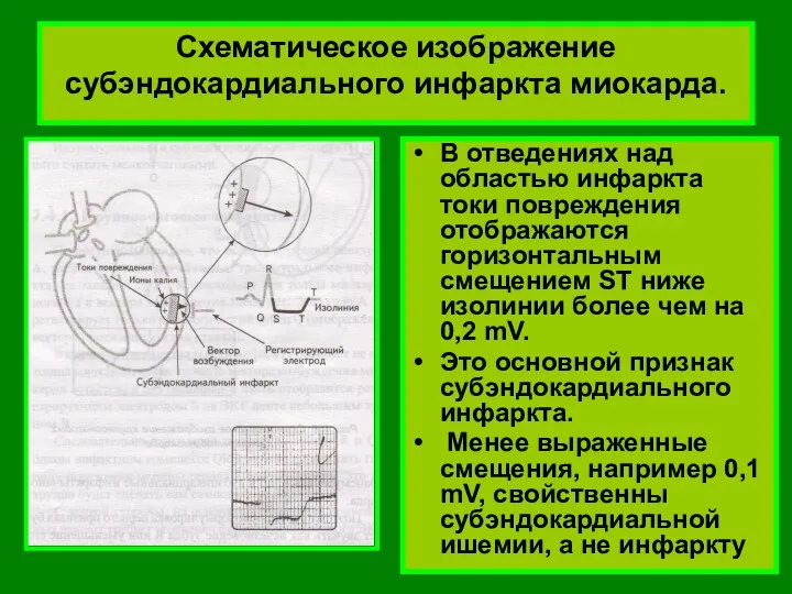 Схематическое изображение субэндокардиального инфаркта миокарда. В отведениях над областью инфаркта