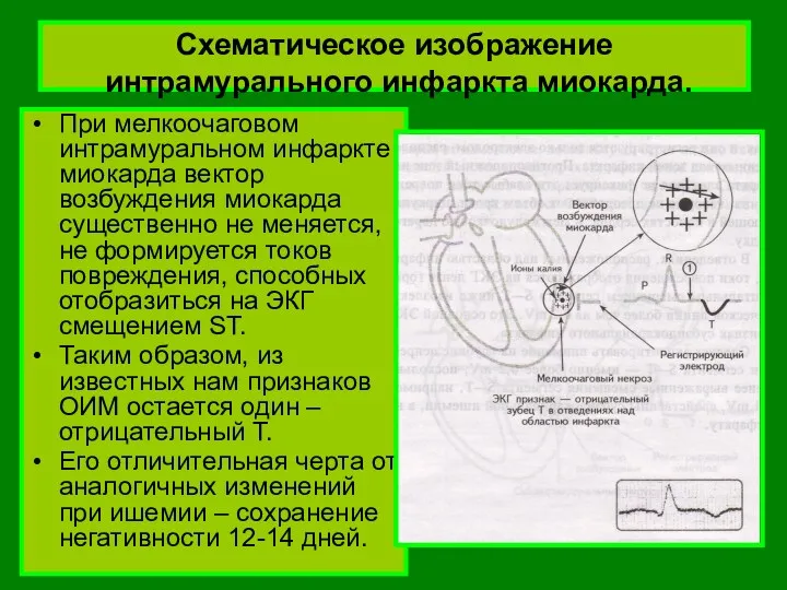 Схематическое изображение интрамурального инфаркта миокарда. При мелкоочаговом интрамуральном инфаркте миокарда вектор возбуждения миокарда