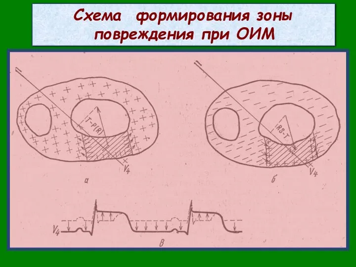 Схема формирования зоны повреждения при ОИМ