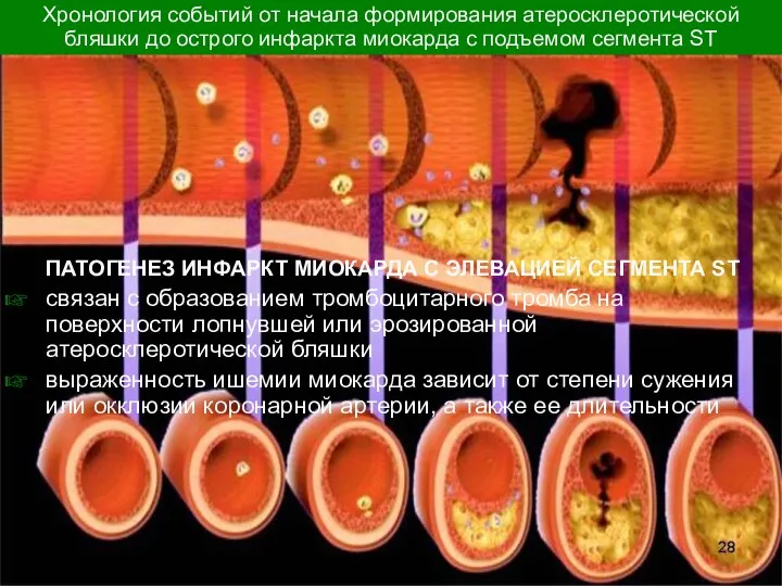 ПАТОГЕНЕЗ ИНФАРКТ МИОКАРДА С ЭЛЕВАЦИЕЙ СЕГМЕНТА ST связан с образованием