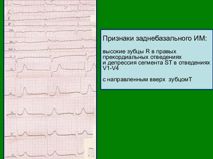 Признаки заднебазального ИМ: высокие зубцы R в правых прекордиальных отведениях