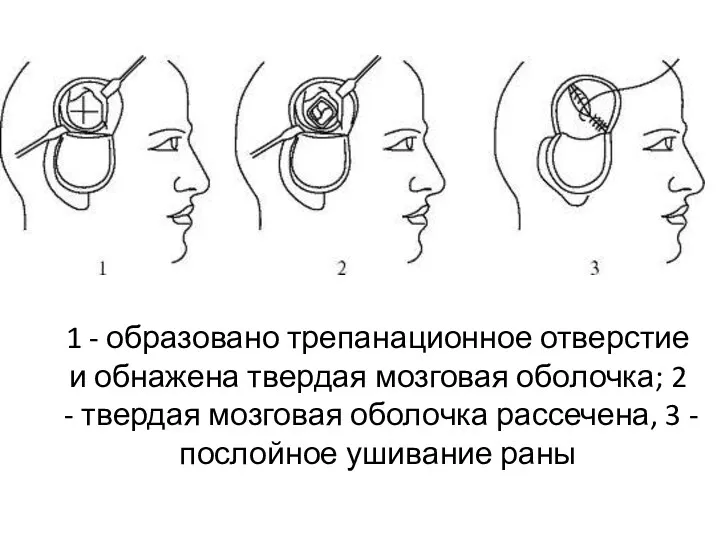 1 - образовано трепанационное отверстие и обнажена твердая мозговая оболочка;