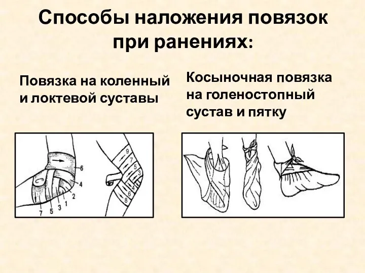 Способы наложения повязок при ранениях: Повязка на коленный и локтевой суставы Косыночная повязка