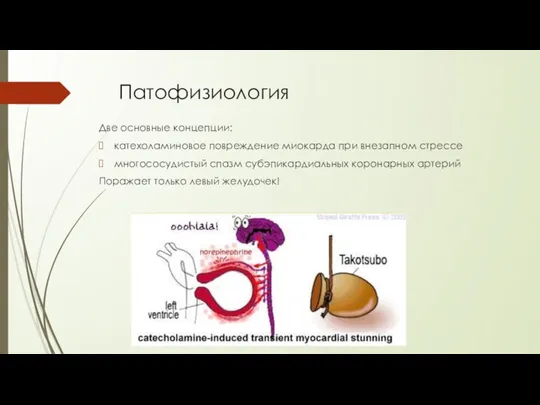Патофизиология Две основные концепции: катехоламиновое повреждение миокарда при внезапном стрессе