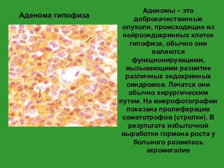 Аденомы – это доброкачественные опухоли, происходящие из нейроэндокринных клеток гипофиза,