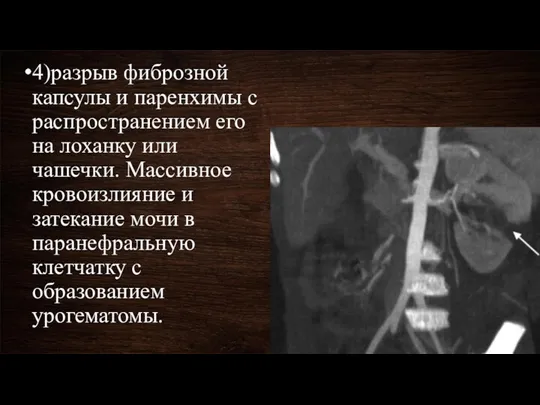 4)разрыв фиброзной капсулы и паренхимы с распространением его на лоханку или чашечки. Массивное