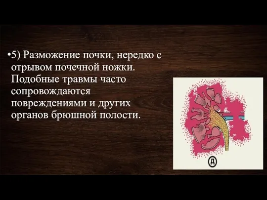 5) Разможение почки, нередко с отрывом почечной ножки. Подобные травмы часто сопровождаются повреждениями