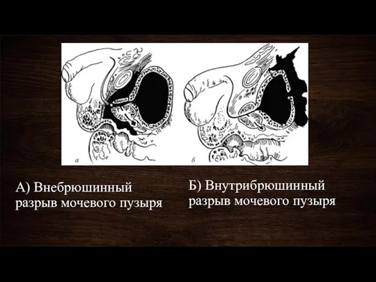 А) Внебрюшинный разрыв мочевого пузыря Б) Внутрибрюшинный разрыв мочевого пузыря