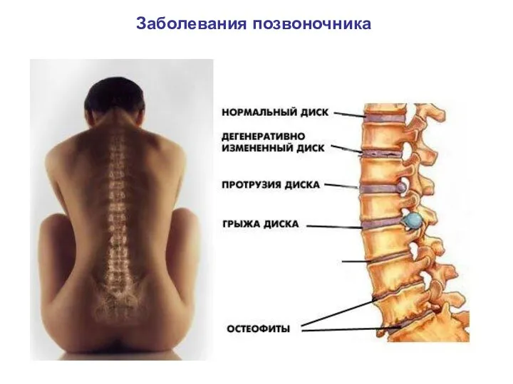 Заболевания позвоночника