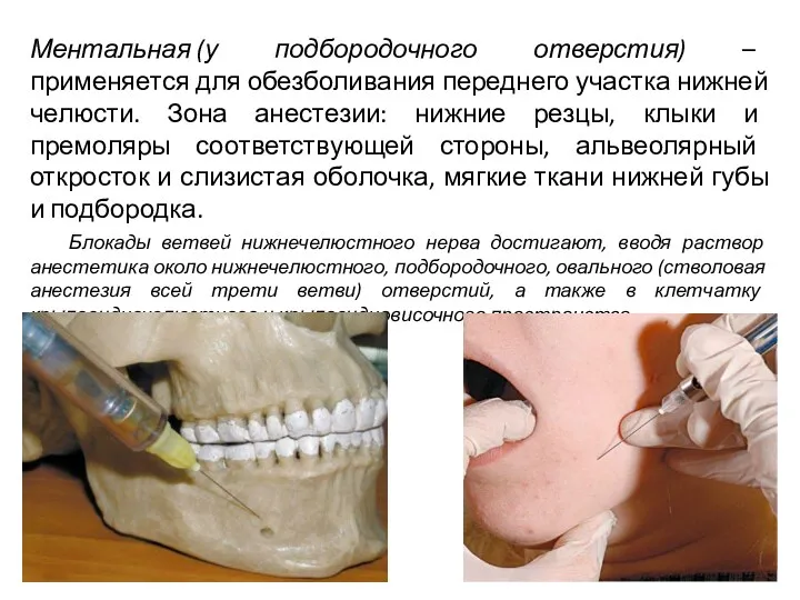 Ментальная (у подбородочного отверстия) – применяется для обезболивания переднего участка