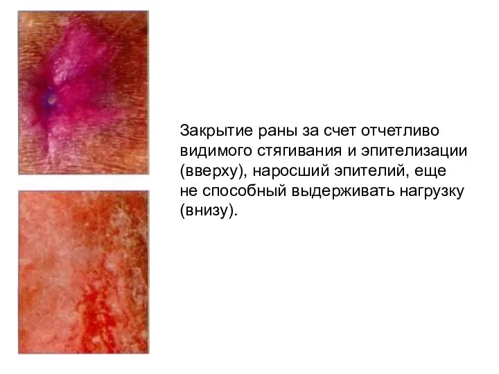 Закрытие раны за счет отчетливо видимого стягивания и эпителизации (вверху),