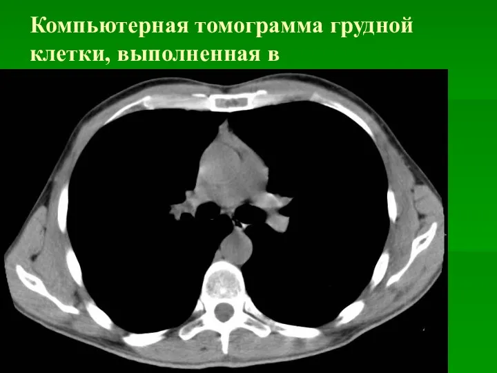 Компьютерная томограмма грудной клетки, выполненная в медиастинальном режиме.