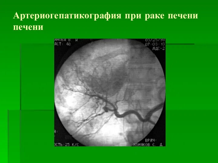 Артериогепатикография при раке печени печени