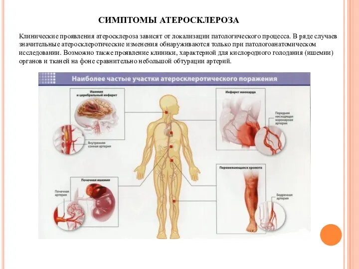 СИМПТОМЫ АТЕРОСКЛЕРОЗА Клинические проявления атеросклероза зависят от локализации патологического процесса. В ряде случаев