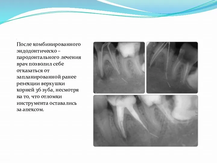 . После комбинированного эндодонтическо – пародонтального лечения врач позволил себе