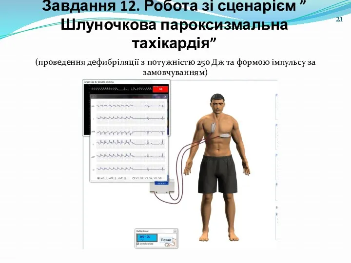 Завдання 12. Робота зі сценарієм ”Шлуночкова пароксизмальна тахікардія” (проведення дефибріляції з потужністю 250