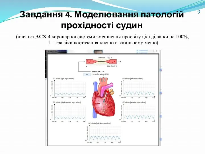 Завдання 4. Моделювання патологій прохідності судин (ділянка ACX-4 коронарної системи,зменшення просвіту цієї ділянки