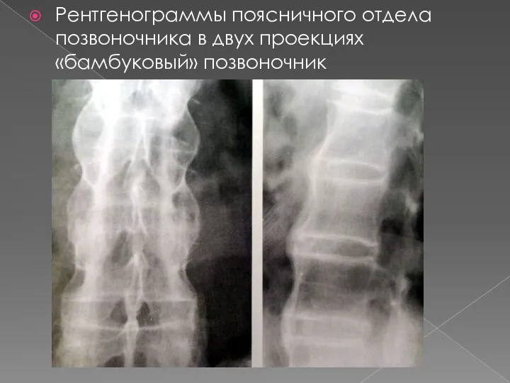 Рентгенограммы поясничного отдела позвоночника в двух проекциях «бамбуковый» позвоночник