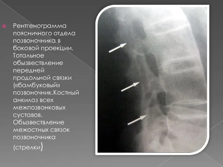 Рентгенограмма поясничного отдела позвоночника в боковой проекции.Тотальное обызвествление передней продольной связки («бамбуковый» позвоночник.Костный