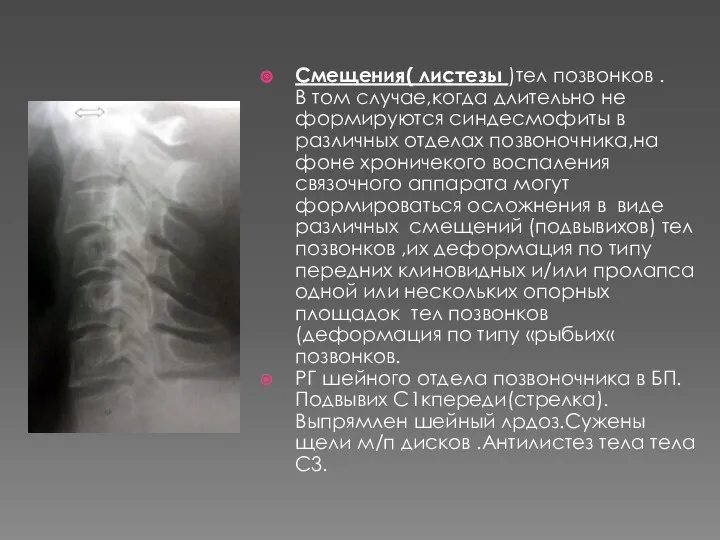 Смещения( листезы )тел позвонков . В том случае,когда длительно не формируются синдесмофиты в