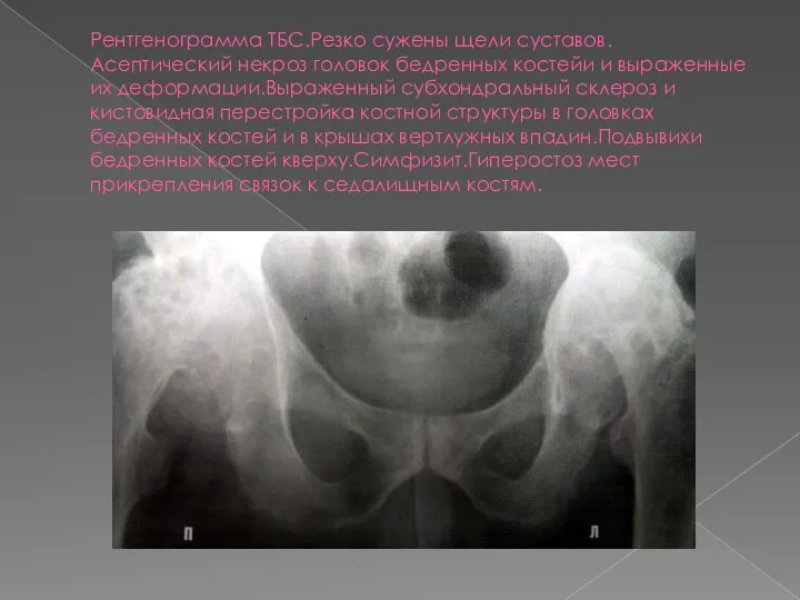 Рентгенограмма ТБС.Резко сужены щели суставов.Асептический некроз головок бедренных костейи и выраженные их деформации.Выраженный