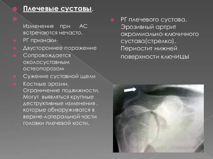 Плечевые суставы. Изменения при АС встречаются нечасто. РГ признаки- Двустороннее поражение Сопровождается околосуставным