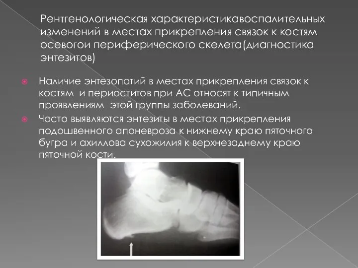 Рентгенологическая характеристикавоспалительных изменений в местах прикрепления связок к костям осевогои периферического скелета(диагностика энтезитов)
