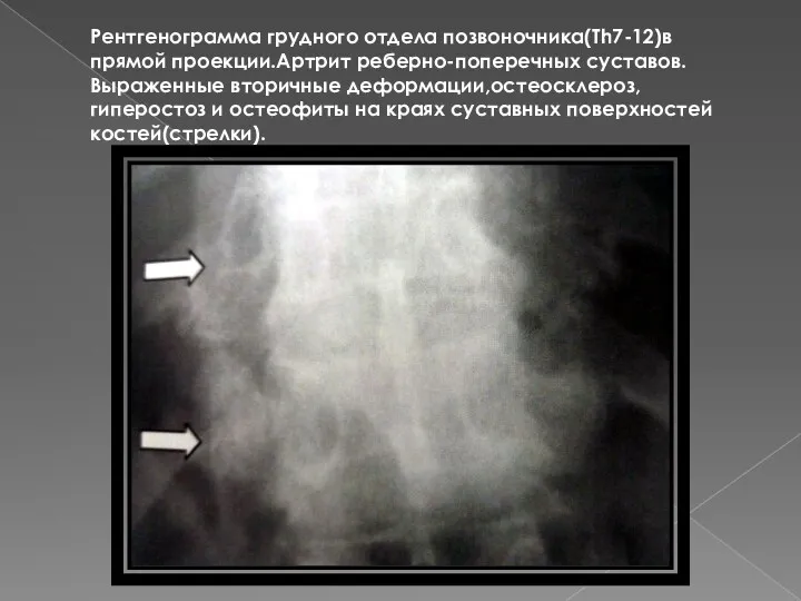 Рентгенограмма грудного отдела позвоночника(Th7-12)в прямой проекции.Артрит реберно-поперечных суставов.Выраженные вторичные деформации,остеосклероз,гиперостоз и остеофиты на