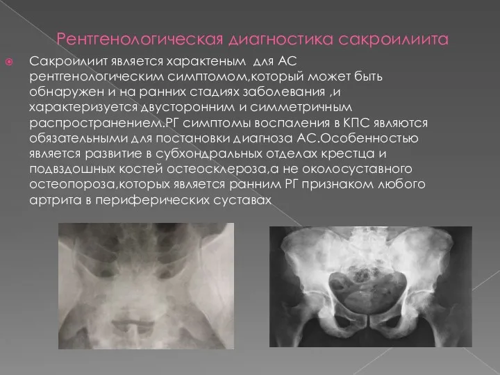 Рентгенологическая диагностика сакроилиита Сакроилиит является характеным для АС рентгенологическим симптомом,который может быть обнаружен