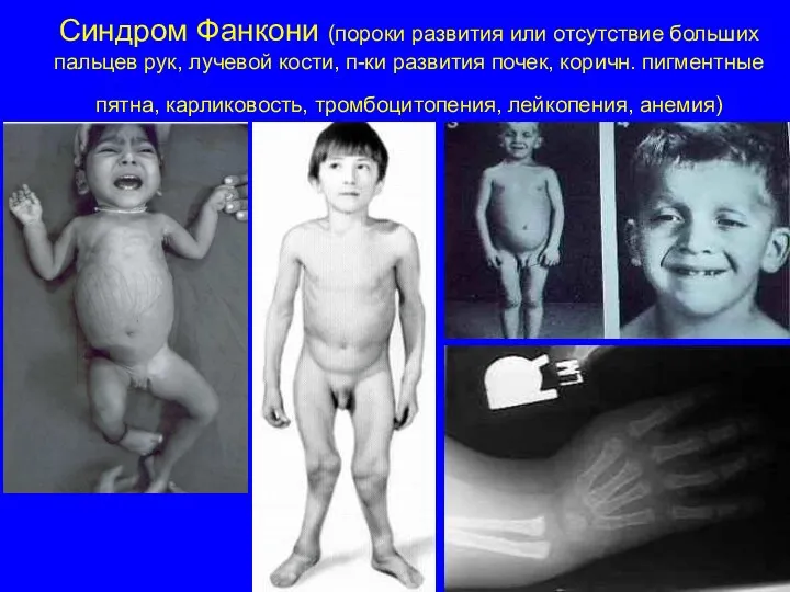 Синдром Фанкони (пороки развития или отсутствие больших пальцев рук, лучевой