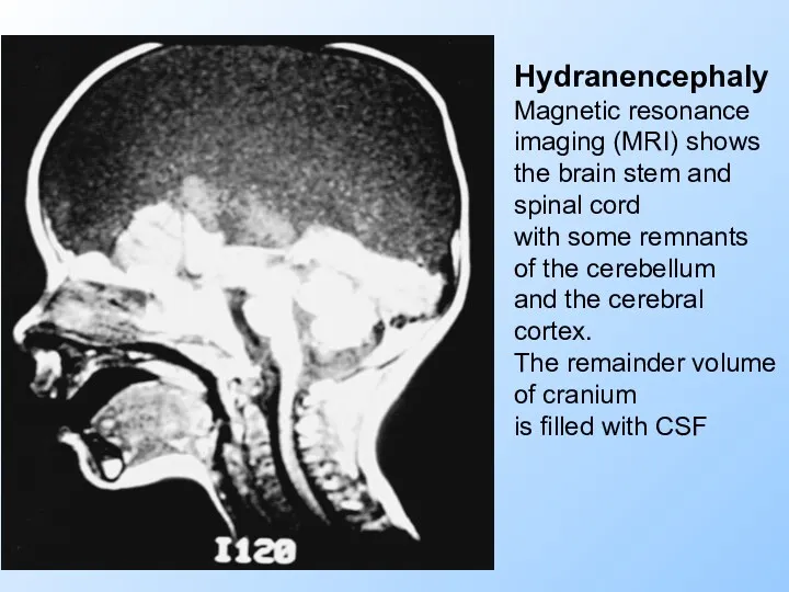 Hydranencephaly Magnetic resonance imaging (MRI) shows the brain stem and