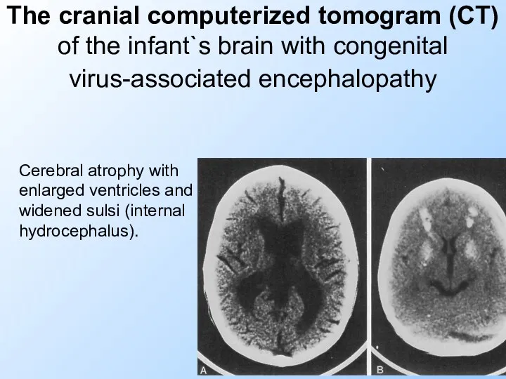 The cranial computerized tomogram (CT) of the infant`s brain with