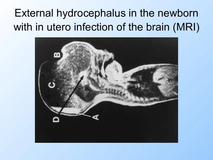 External hydrocephalus in the newborn with in utero infection of the brain (MRI)