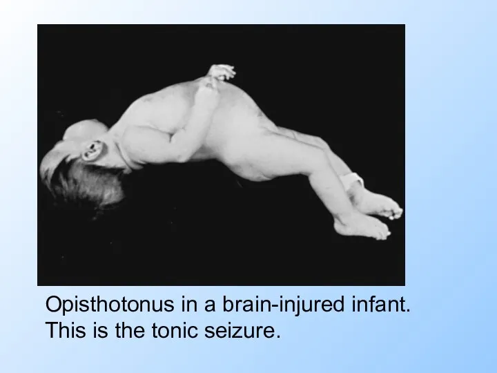 Opisthotonus in a brain-injured infant. This is the tonic seizure.