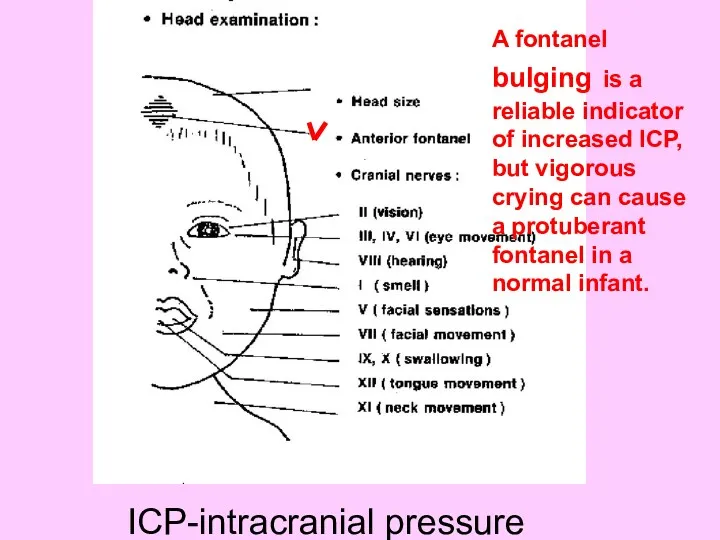 A fontanel bulging is a reliable indicator of increased ICP,