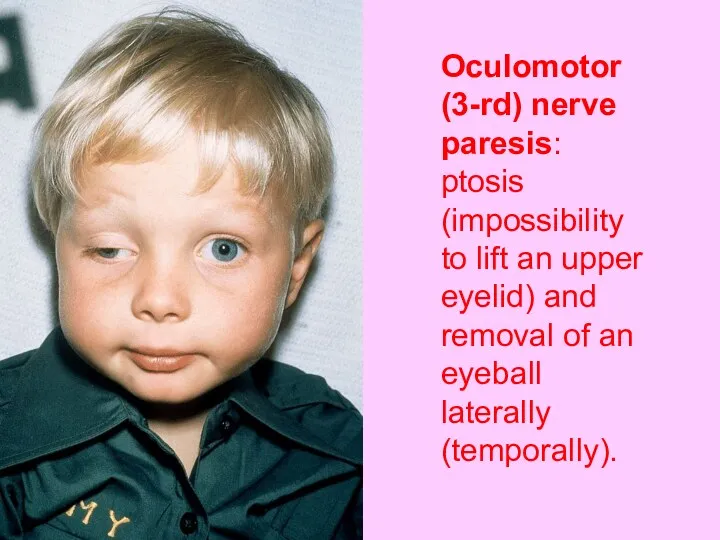 Oculomotor (3-rd) nerve paresis: ptosis (impossibility to lift an upper