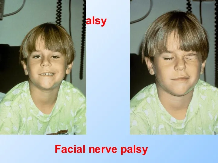 Facial nerve palsy Facial nerve palsy