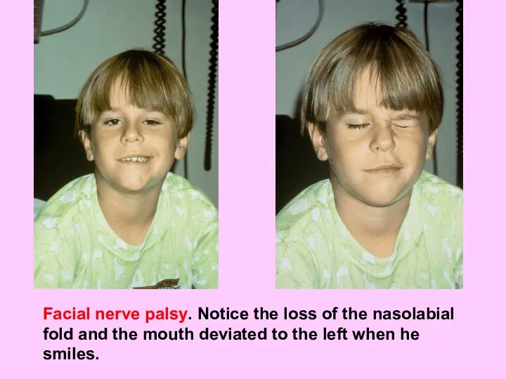 Facial nerve palsy. Notice the loss of the nasolabial fold