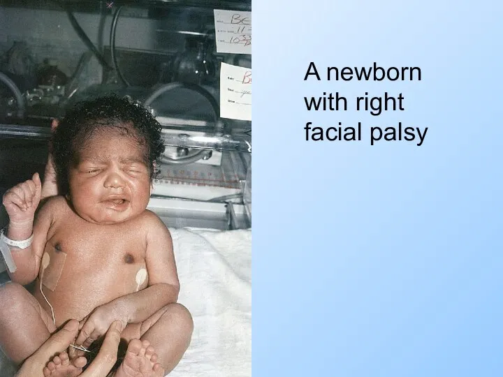 A newborn with right facial palsy