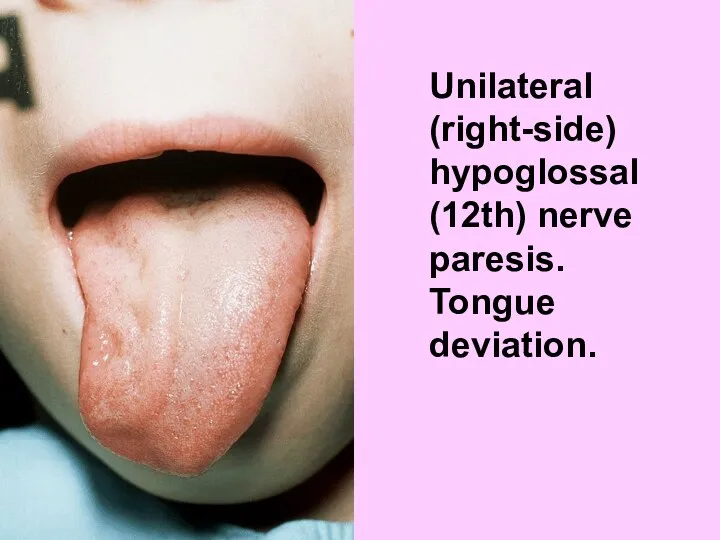 Unilateral (right-side) hypoglossal (12th) nerve paresis. Tongue deviation.