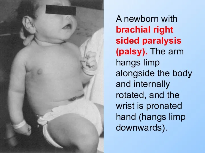A newborn with brachial right sided paralysis (palsy). The arm